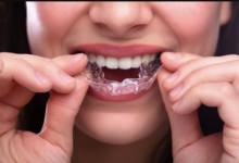 Integrating Patient Specific Occlusal Splints Into Comprehensive Smile Rehabilitation